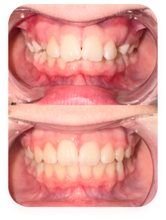 Patient 10 years old — before and 16 months in