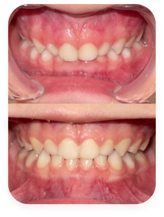 Patient 5 years old — before and 1 year in