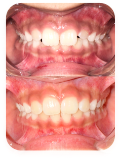 Patient 7 years old — before and 14 months in