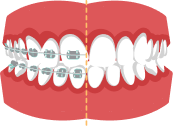 Avoid Braces