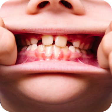 Bite down (all teeth)