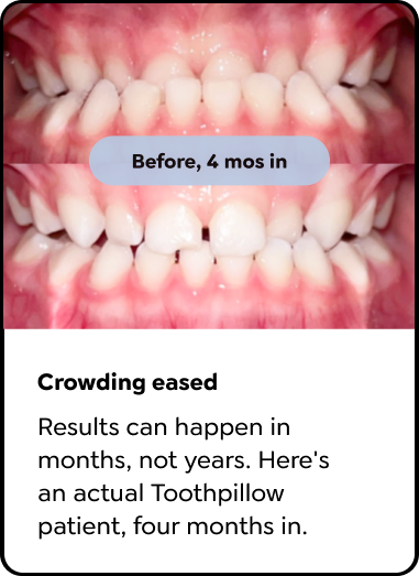 Crowding eased in 4 months. Results can happen in months, not years.