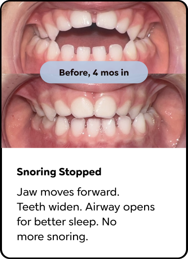 Snoring stopped. Jaw moves forward, teeth widen, airway opens for better sleep.