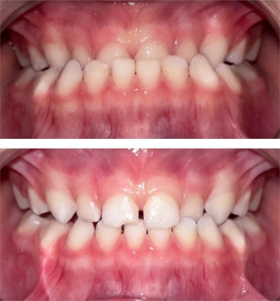 Before and four months in