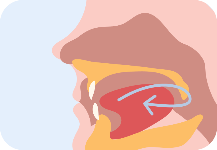 Cross-section illustration of an underdeveloped jaw with the tongue falling backward, narrowing the airway